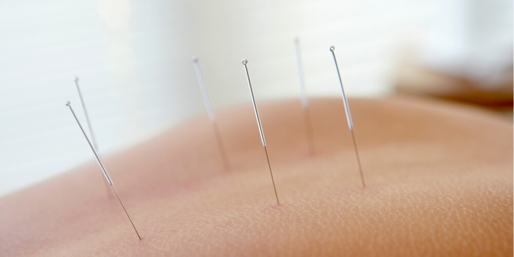 Çocuklarda Akupunktur Uygulamaları