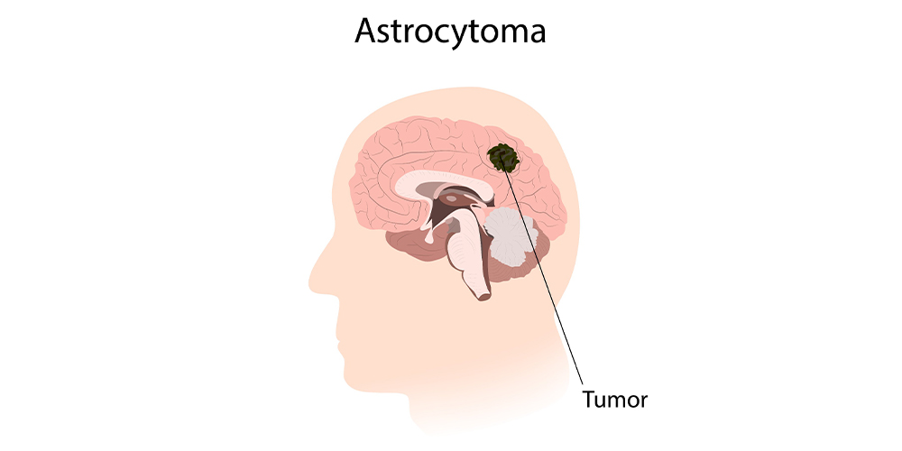 Astrositoma Nedir? Tipleri ve Tedavi Yöntemleri Nelerdir?