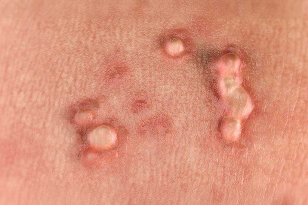 HPV ve Sigil Genital Sigil