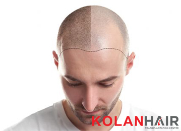 Kolan Hair