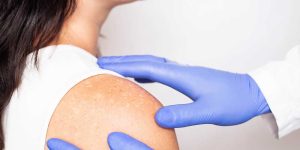 Keratosis Pilaris Tedavisi