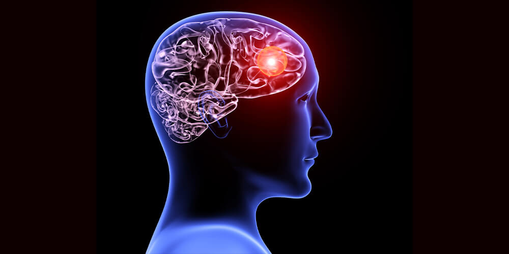 Beyin Tumoru Nedir