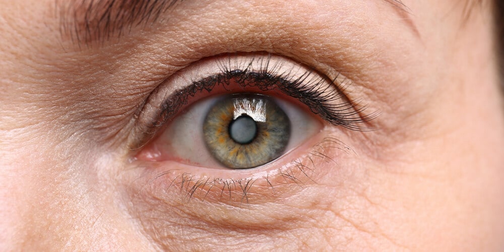 Katarakt Belirtileri Nelerdir